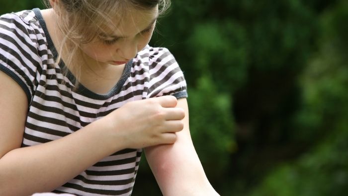 Natural Home Remedies for Mosquito Bites photo